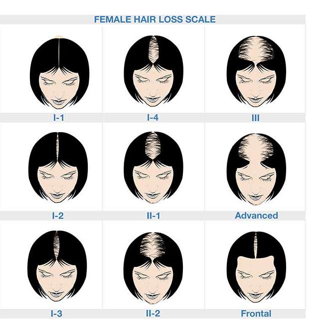 Ludwig scale  Types of hair loss – Neofollics